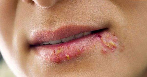 Herpes sederhana, apa itu dan implikasinya