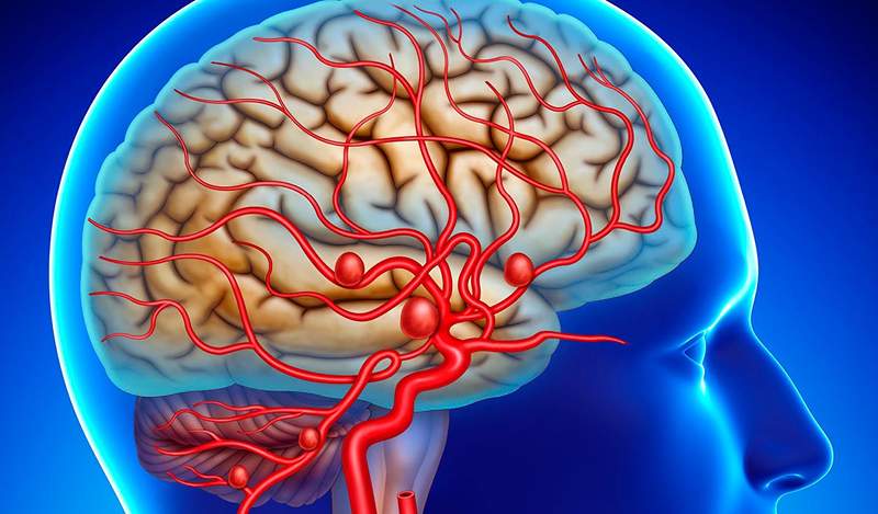 Aneurismas cerebrais, sinais, diagnóstico e tratamento