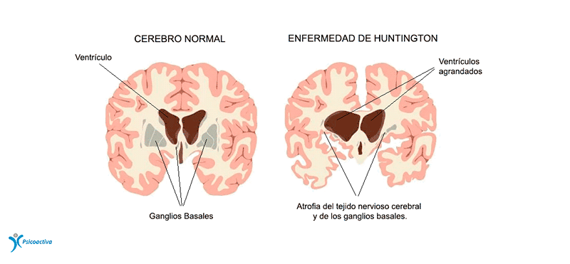 Huntington Kórea alebo tanec San Vito