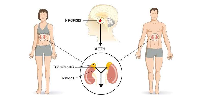 Cushing Syndrome, apa itu?