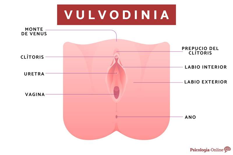 Vulvodynia Ce este, simptome, cauze și tratament